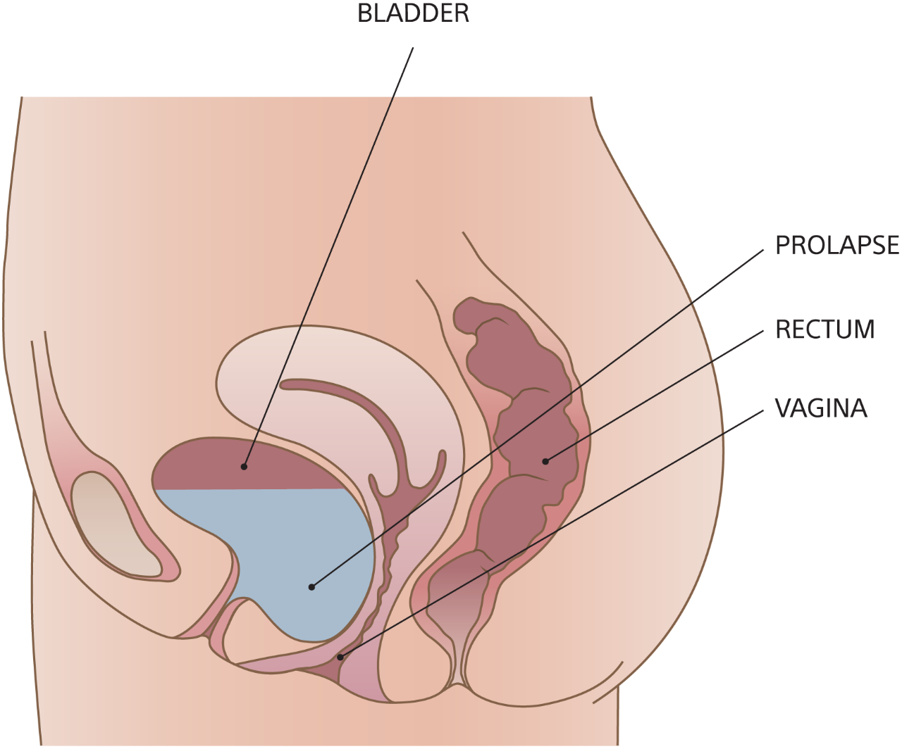 Illustration of cystocele.