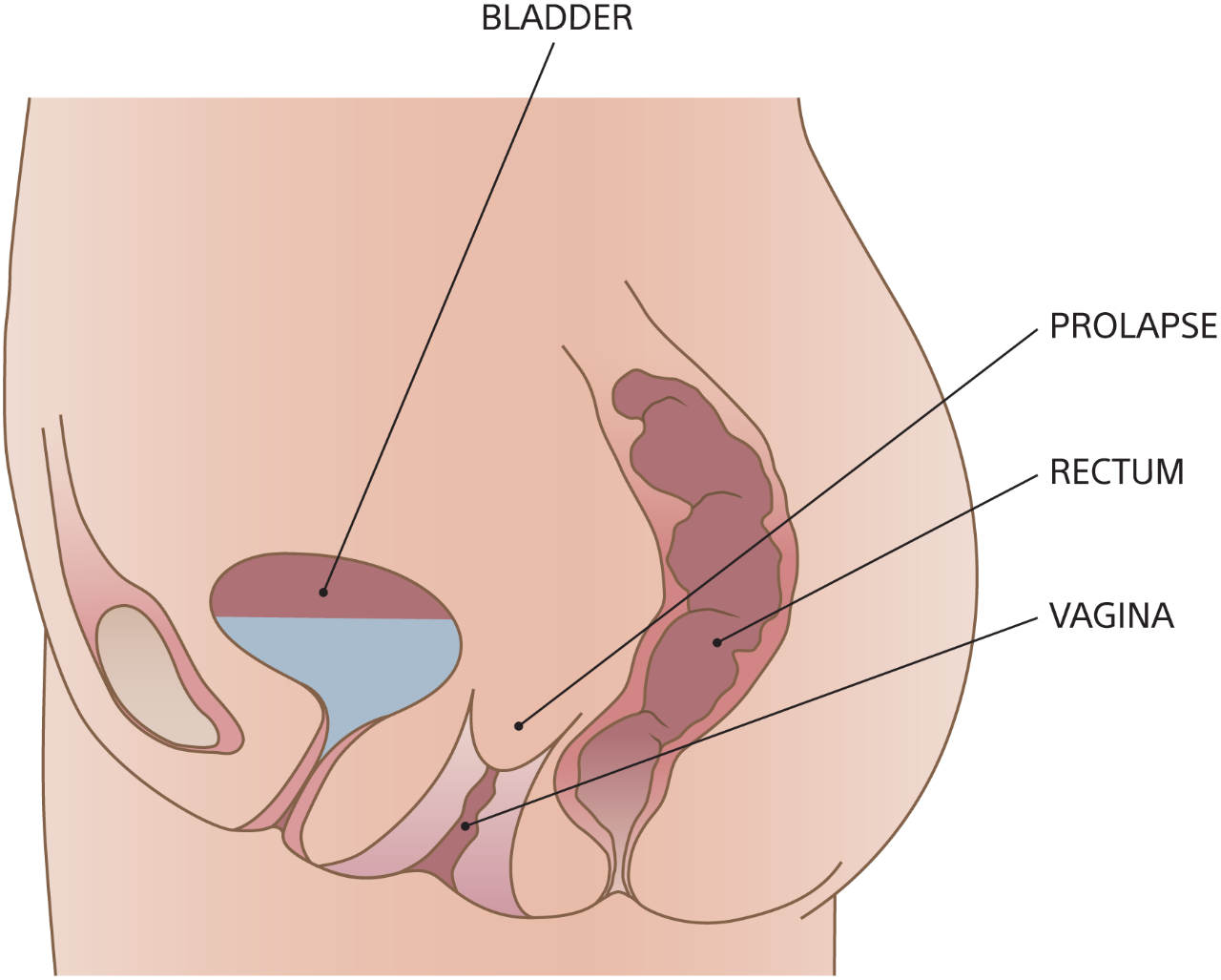 Illustration of vaginal vault prolapse.